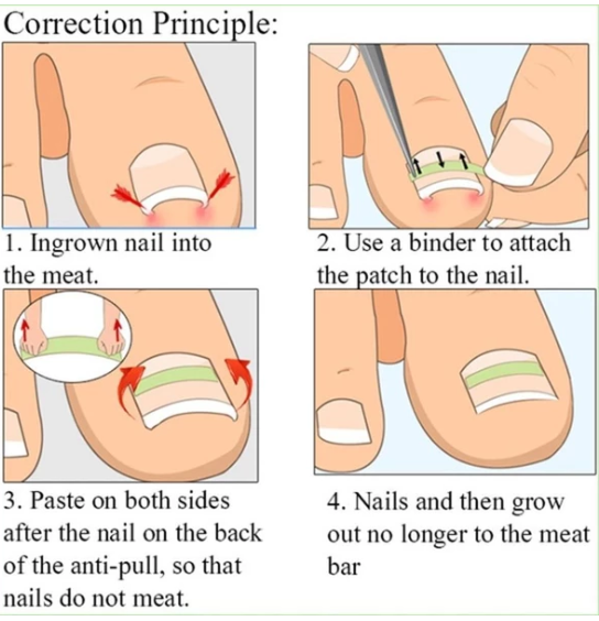 Nail patch - NJPH Best Selling 